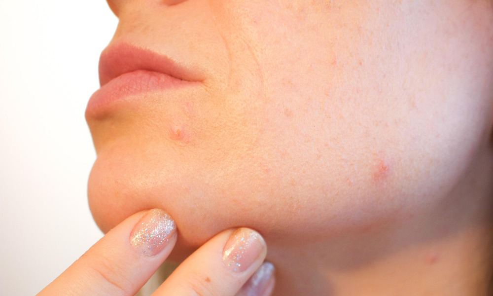 antifungal creams for fungal acne​