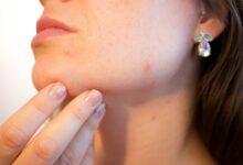 stages of a blind pimple