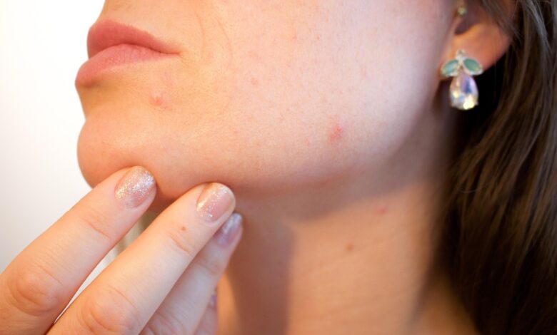 stages of a blind pimple